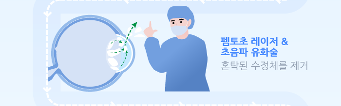 다초점 노안 백내장 수술이란? / 강남 스마일안과,강남 안과 추천 사진 5