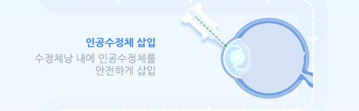 다초점 노안 백내장 수술이란? / 강남 스마일안과,강남 안과 추천 사진 6