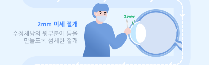 다초점 노안 백내장 수술이란? / 강남 스마일안과,강남 안과 추천 사진 4