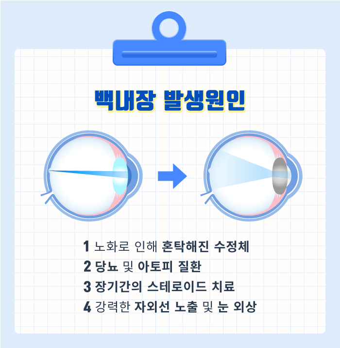 [白內障] 眼睛模糊不清的白內障發生原因？！ 사진 3