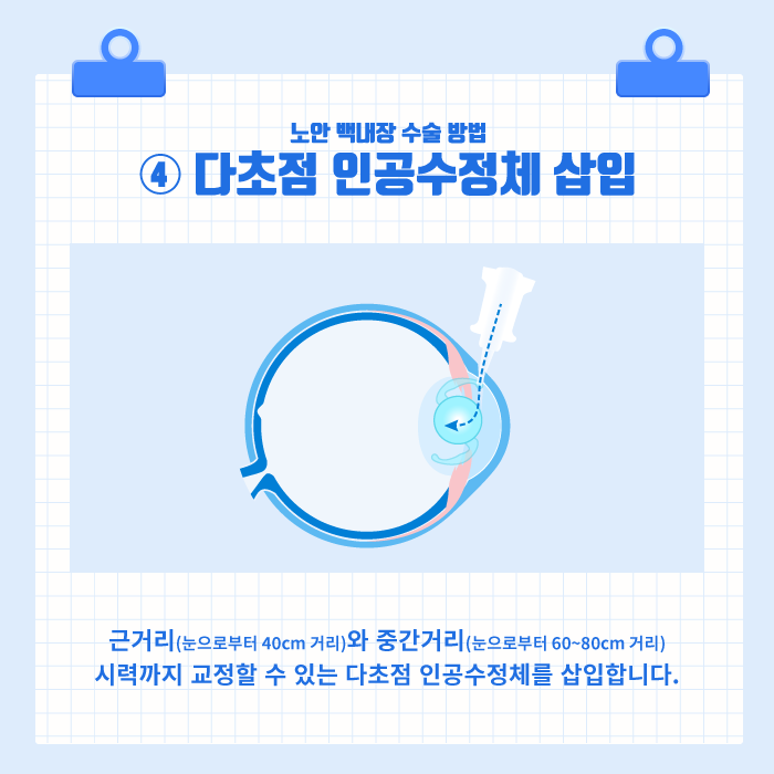 [노안/백내장] 백내장과 노안, 굴절이상을 동시에 교정하는 노안 백내장 수술! 사진 6
