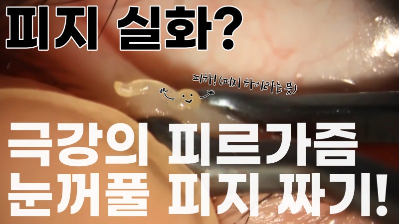 บีบไขมันเปลือกตา! / การบีบไขมันเปลือกตาที่กำลังฮิตในคอมมูนิตี้ / Gangnam Smile Eye Clinic (feat. Pirgasm)