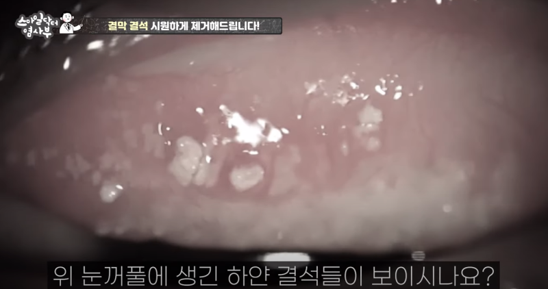 [สไมล์ด็อกเตอร์ย็อมซาบูทีวี] มีหินออกมาจากตา?! / วิดีโอการกำจัดนิ่วในเยื่อบุตา / โรงพยาบาลจักษุคังนัมสไมล์อาย