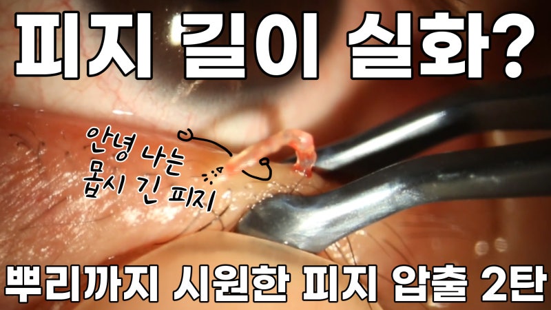 การบีบไขมันเปลือกตาที่ Gangnam Smile Eye Clinic 2! / ไขมันเปลือกตาที่ยาวที่สุดในโลก!! (feat. Pirgasm)