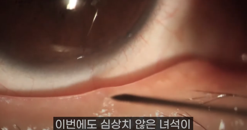 การบีบไขมันเปลือกตาที่ Gangnam Smile Eye Clinic 2! / ไขมันเปลือกตาที่ยาวที่สุดในโลก!! (feat. Pirgasm) 사진 5