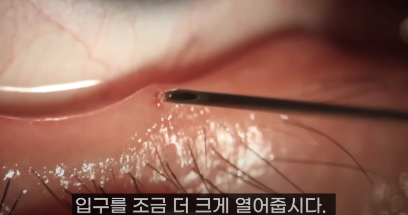 การบีบไขมันเปลือกตาที่ Gangnam Smile Eye Clinic 2! / ไขมันเปลือกตาที่ยาวที่สุดในโลก!! (feat. Pirgasm) 사진 9