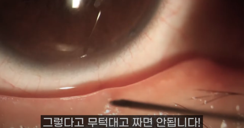การบีบไขมันเปลือกตาที่ Gangnam Smile Eye Clinic 2! / ไขมันเปลือกตาที่ยาวที่สุดในโลก!! (feat. Pirgasm) 사진 7