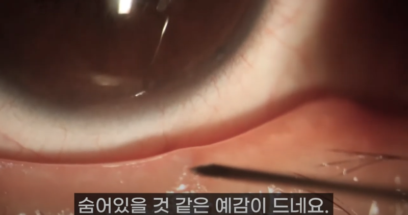 การบีบไขมันเปลือกตาที่ Gangnam Smile Eye Clinic 2! / ไขมันเปลือกตาที่ยาวที่สุดในโลก!! (feat. Pirgasm) 사진 6