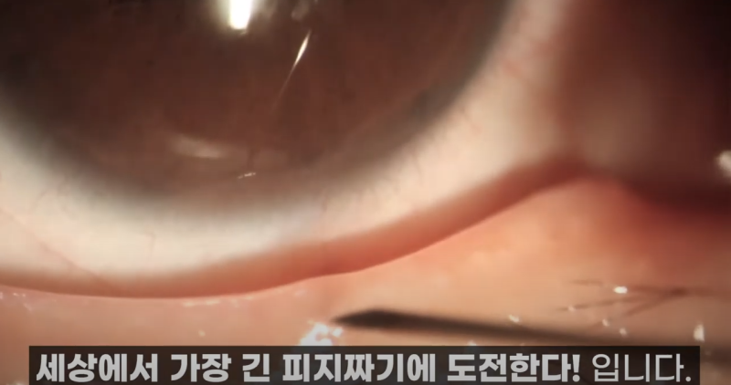 การบีบไขมันเปลือกตาที่ Gangnam Smile Eye Clinic 2! / ไขมันเปลือกตาที่ยาวที่สุดในโลก!! (feat. Pirgasm) 사진 3