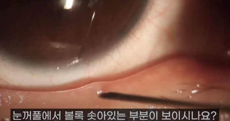 การบีบไขมันเปลือกตาที่ Gangnam Smile Eye Clinic 2! / ไขมันเปลือกตาที่ยาวที่สุดในโลก!! (feat. Pirgasm) 사진 4