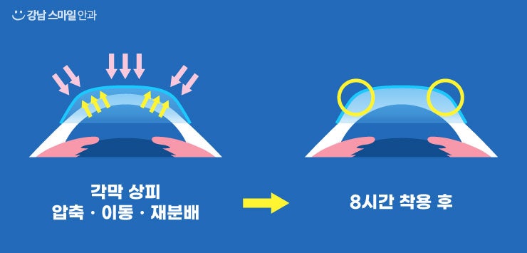 【江南Smile眼科】未成年人可以进行视力矫正吗？？ 사진 5