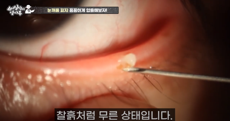 การบีบไขมันเปลือกตาที่กลับมาอย่างทรงพลังยิ่งขึ้น 3! / ★★บีบหนองและไขมันเปลือกตาออกหมดจดถึงรากถึงโคนในครั้งเดียว★★ 사진 18