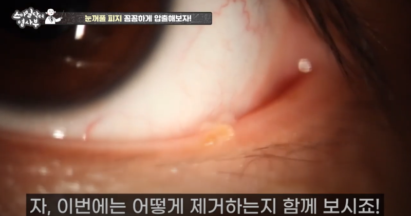 更強勢回歸的眼瞼皮脂擠壓 3! / ★★膿液和眼瞼皮脂一次性徹底清除★★ 사진 10