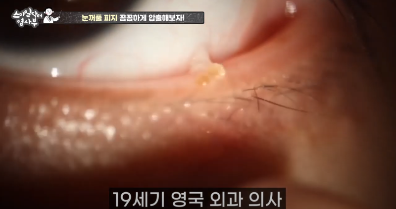 การบีบไขมันเปลือกตาที่กลับมาอย่างทรงพลังยิ่งขึ้น 3! / ★★บีบหนองและไขมันเปลือกตาออกหมดจดถึงรากถึงโคนในครั้งเดียว★★ 사진 8
