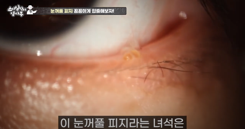 การบีบไขมันเปลือกตาที่กลับมาอย่างทรงพลังยิ่งขึ้น 3! / ★★บีบหนองและไขมันเปลือกตาออกหมดจดถึงรากถึงโคนในครั้งเดียว★★ 사진 4