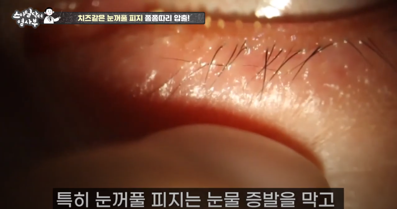 แม้ผ่าตัดต้อกระจกก็ยังสามารถบีบไขมันเปลือกตาได้! ตอนที่ 4 / ★★★รู้หรือไม่ว่าทำไมไขมันถึงมีสีและความแข็งต่างกัน?★★★ 사진 22