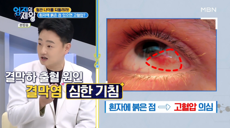 [MBN 엄지의 제왕 421회] ظهور المدير الطبي لعيادة جانجنام سمايل لطب العيون، الدكتور يوم دونج جو، في برنامج استوديو 사진 9
