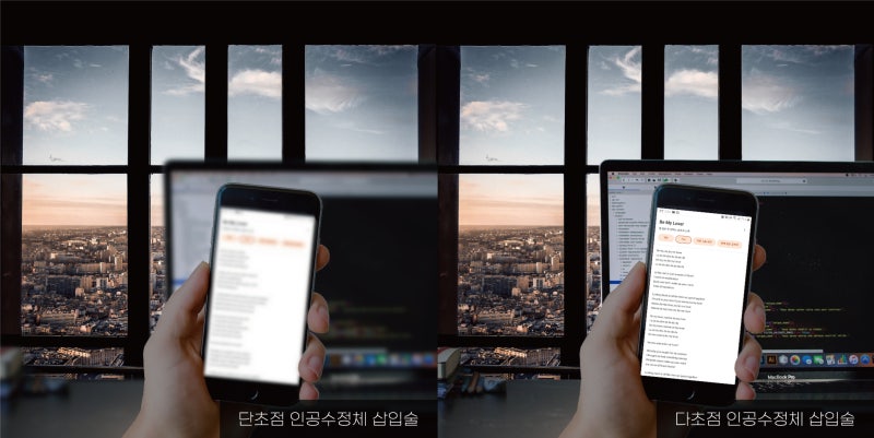 [강남스마일안과] 당신이 미처 알지 못했던 백내장, 2021년 차세대 인공수정체 시너지렌즈