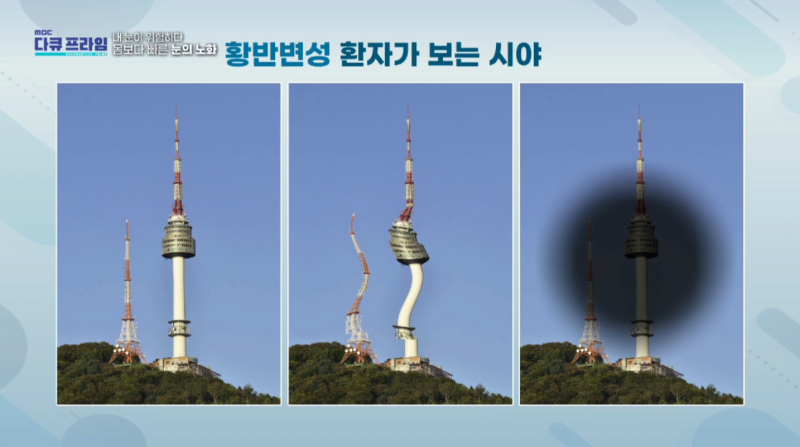 [MBC 다큐프라임 401회] 강남스마일안과 윤효성 원장님 방송 출연 사진 18