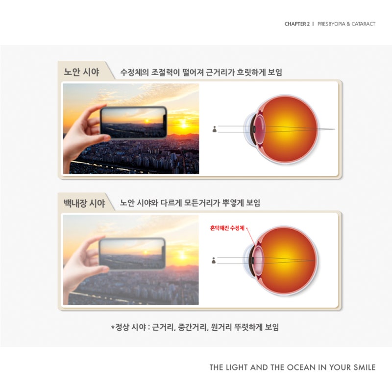 江南Smile眼科《拯救雙眼：老花眼&白內障篇》 사진 5