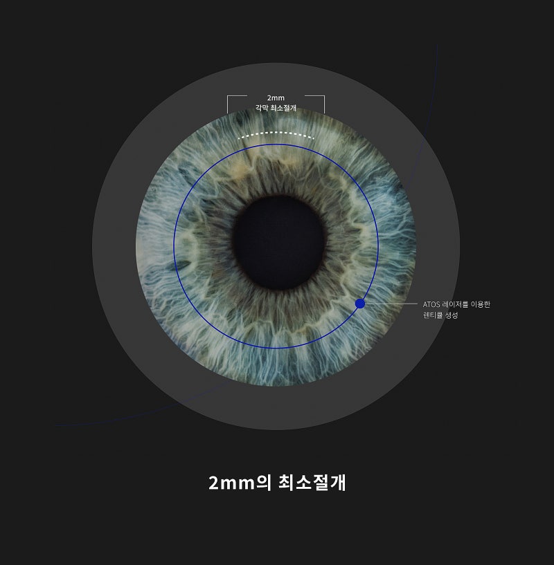 Gangnam Smile Eye Clinic นำเข้าอุปกรณ์ผ่าตัด New Smile LASIK รุ่น Schwind ATOS (ชวินด์ อะทอส)! 사진 3
