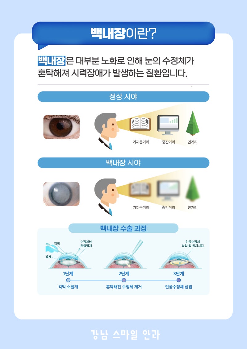 Gangnam Smile Eye Clinic: What is Clareon PanOptix? 사진 5