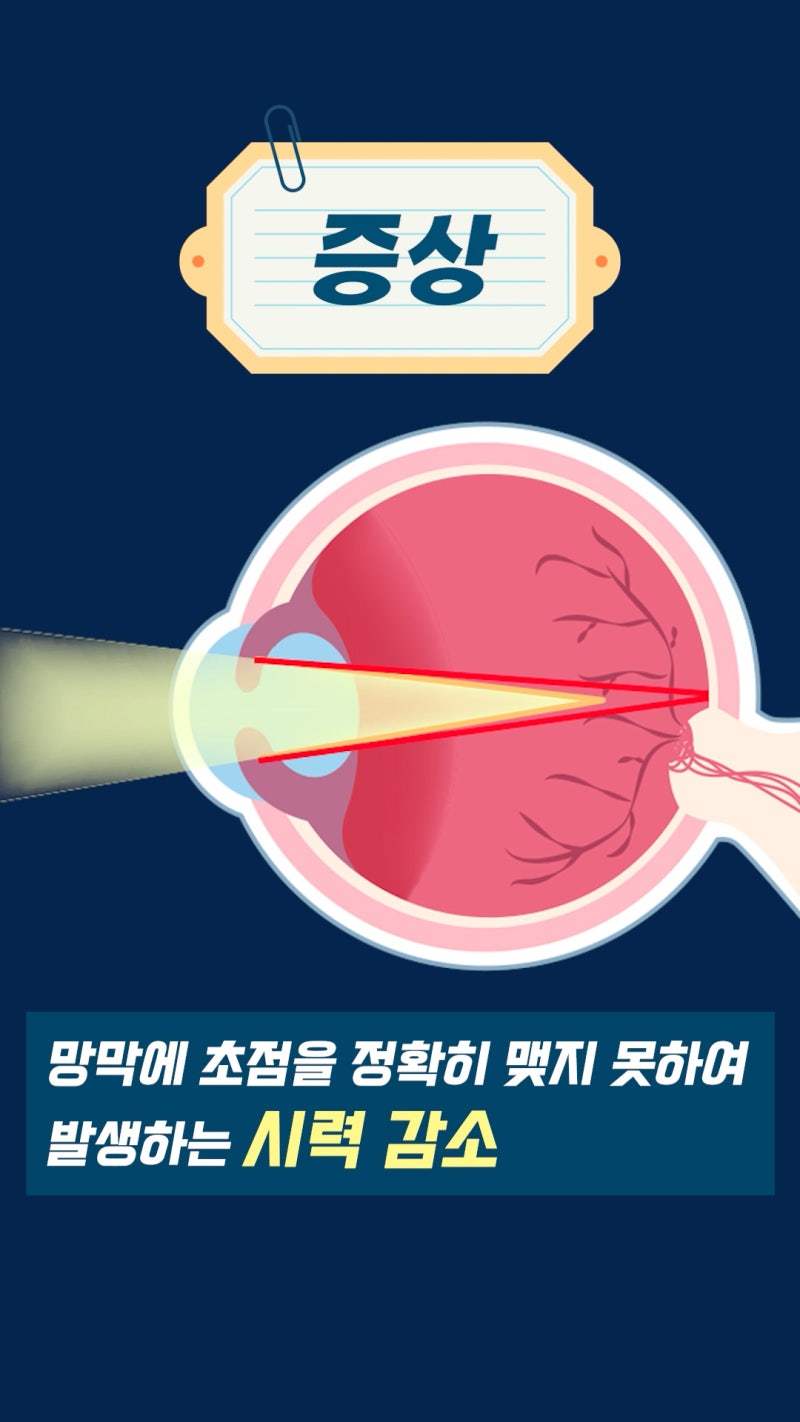 สายตาสั้นคืออะไร? ข้อมูลจักษุวิทยาจาก Gangnam Smile Eye Clinic! 사진 8