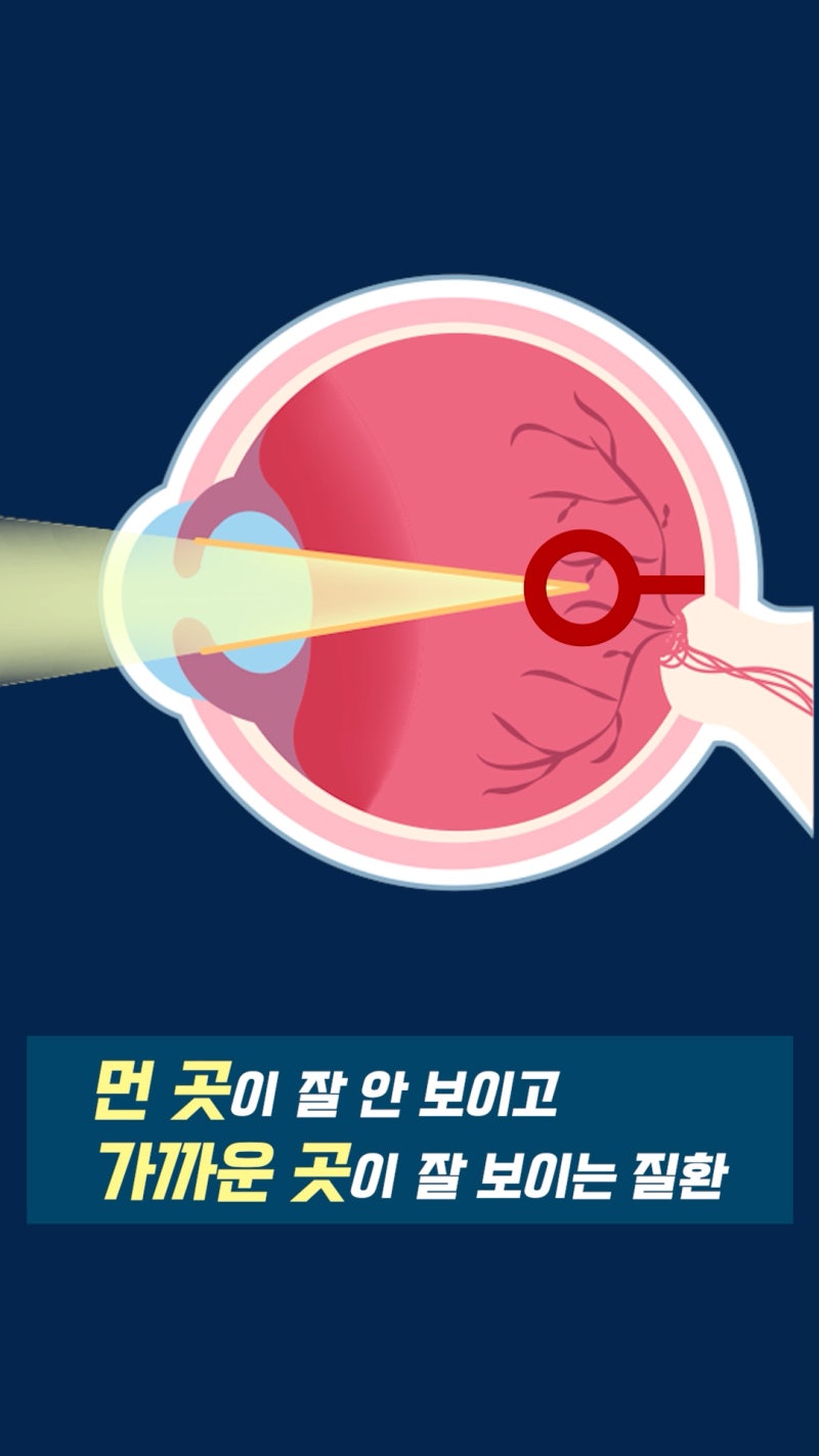 สายตาสั้นคืออะไร? ข้อมูลจักษุวิทยาจาก Gangnam Smile Eye Clinic! 사진 6
