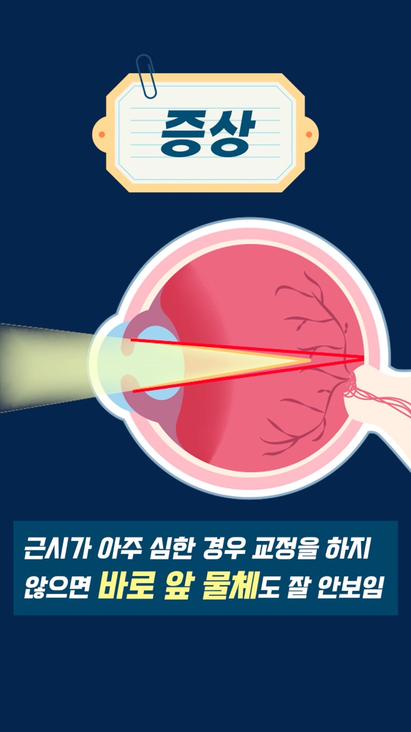 สายตาสั้นคืออะไร? ข้อมูลจักษุวิทยาจาก Gangnam Smile Eye Clinic! 사진 9