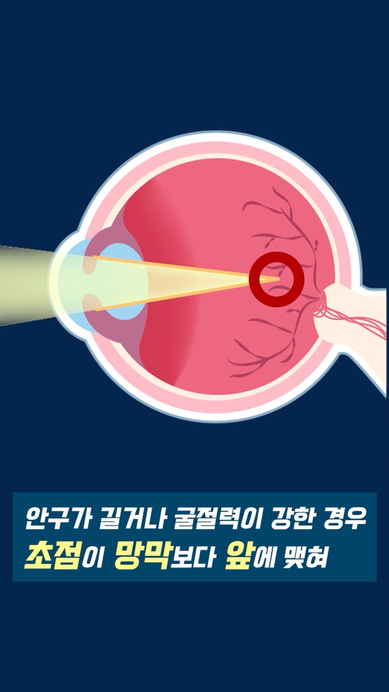 สายตาสั้นคืออะไร? ข้อมูลจักษุวิทยาจาก Gangnam Smile Eye Clinic! 사진 5