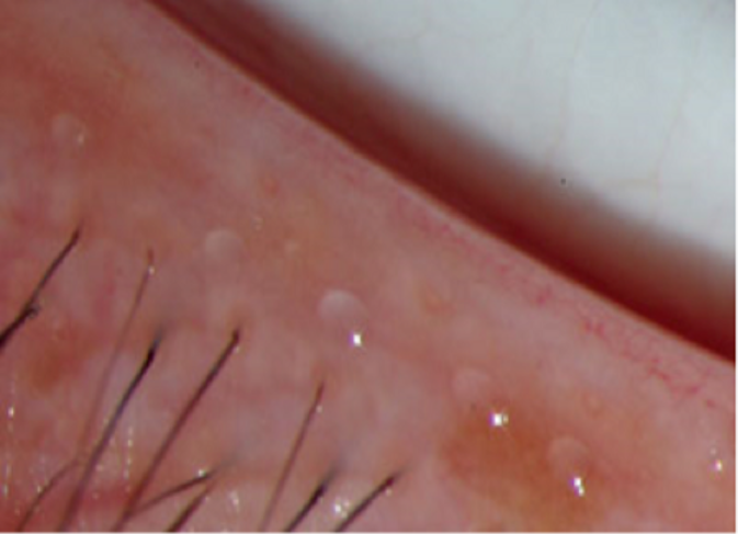 When and How to Clean Your Meibomian Glands? 사진 3
