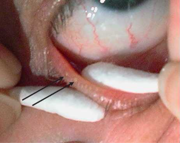 When and How to Clean Your Meibomian Glands? 사진 6