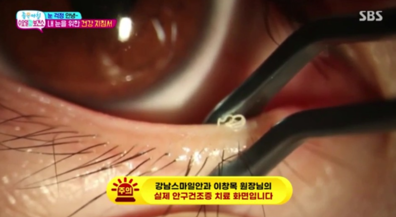 When and How to Clean Your Meibomian Glands? 사진 7