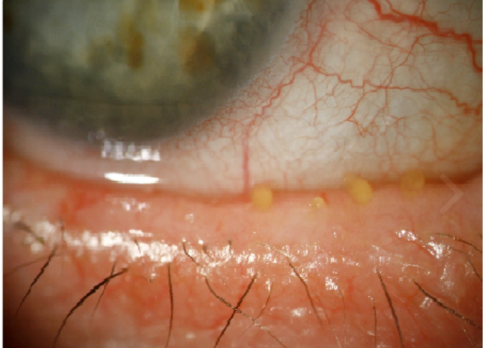 When and How to Clean Your Meibomian Glands? 사진 4