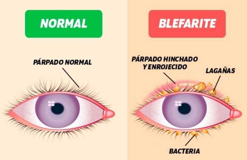 眼瞼炎とは？原因、症状、治療方法 사진 5