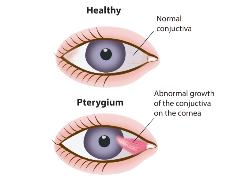 Mộng thịt là gì? Tổng hợp nguyên nhân, triệu chứng và phương pháp điều trị 사진 7