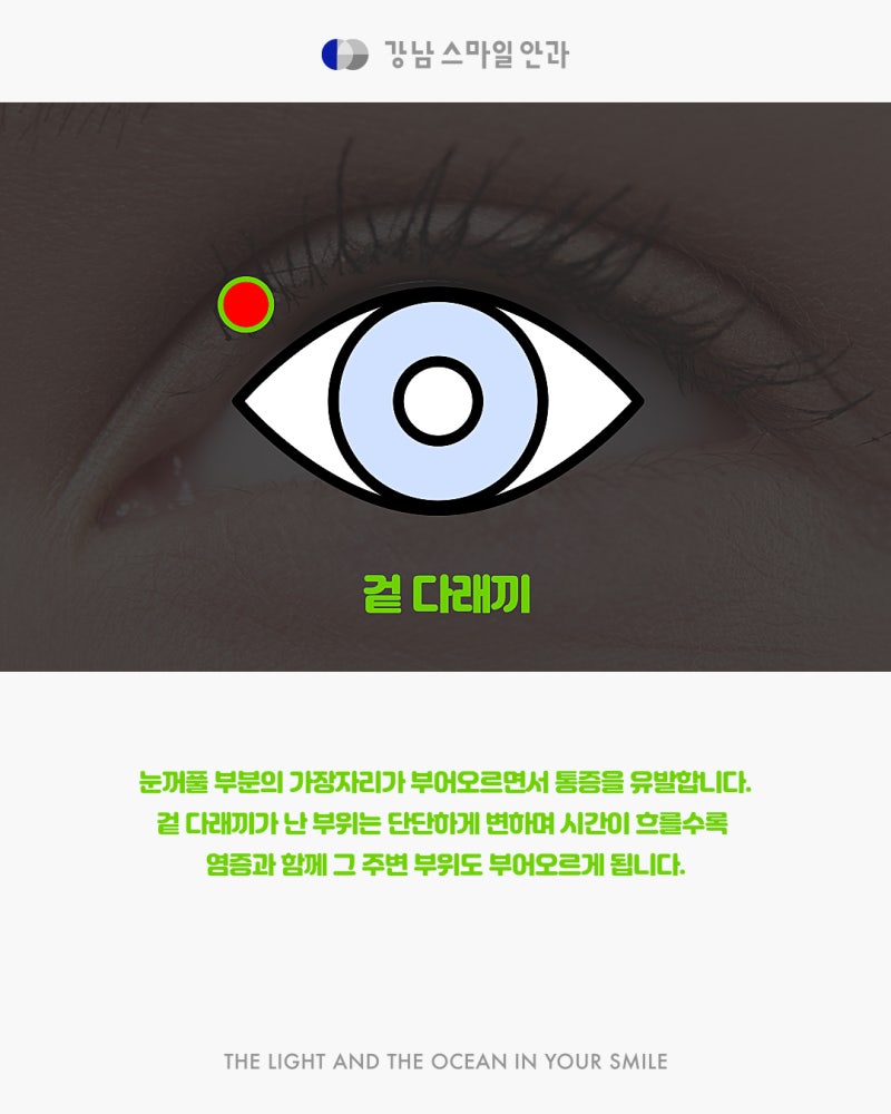 강남역 다래끼 치료 잘하는 곳을 찾고 있다면? 사진 4