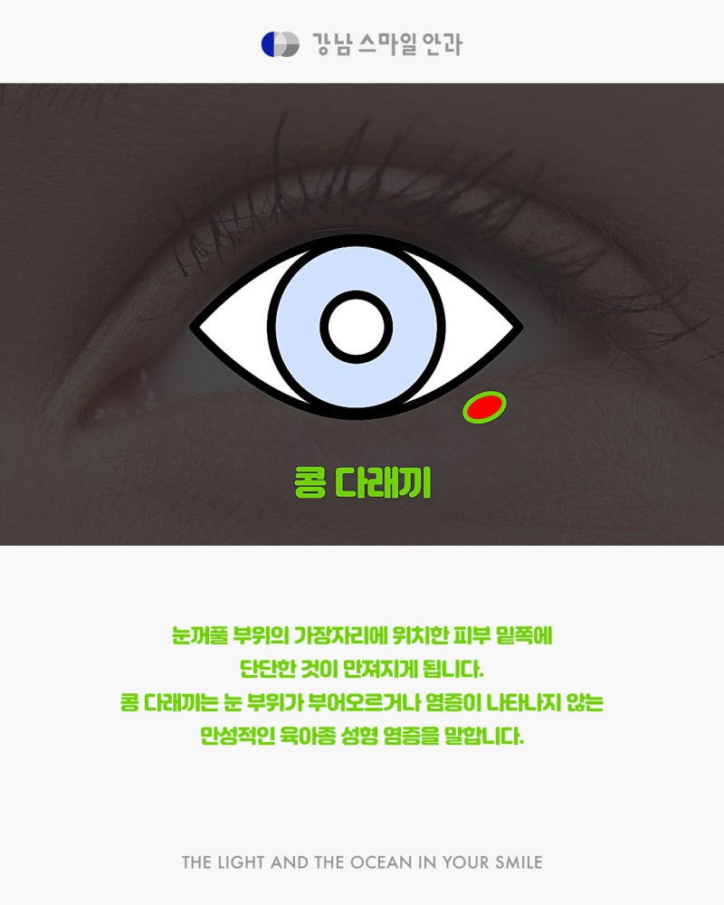 강남역 다래끼 치료 잘하는 곳을 찾고 있다면? 사진 3
