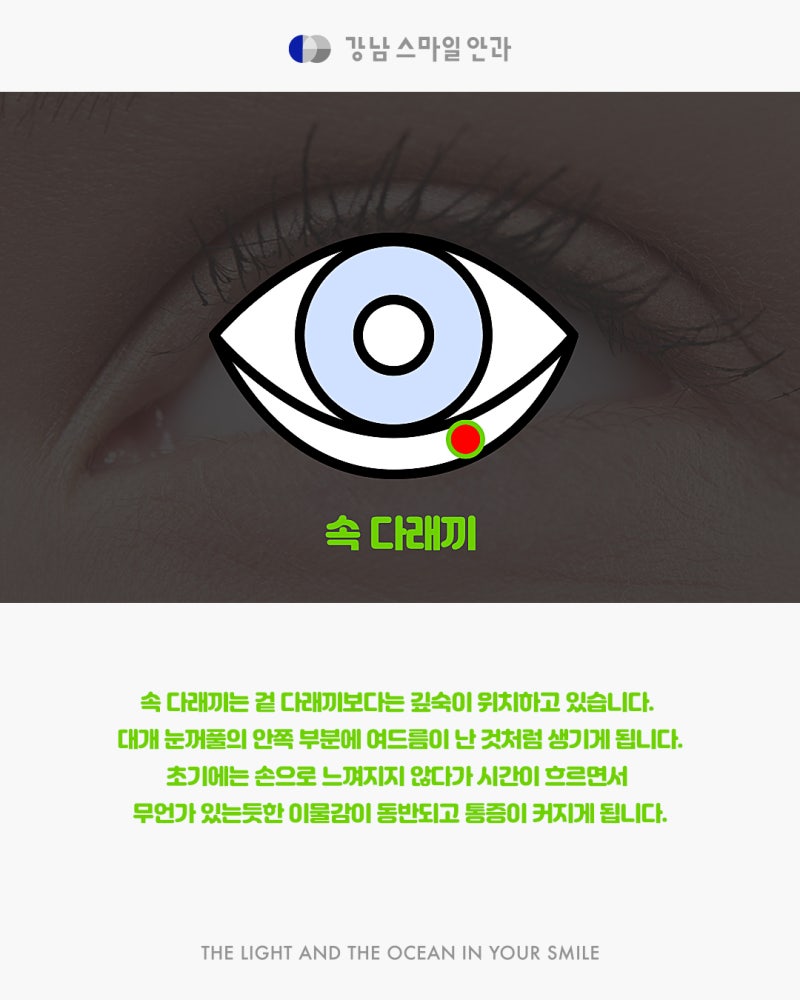 강남역 다래끼 치료 잘하는 곳을 찾고 있다면? 사진 5