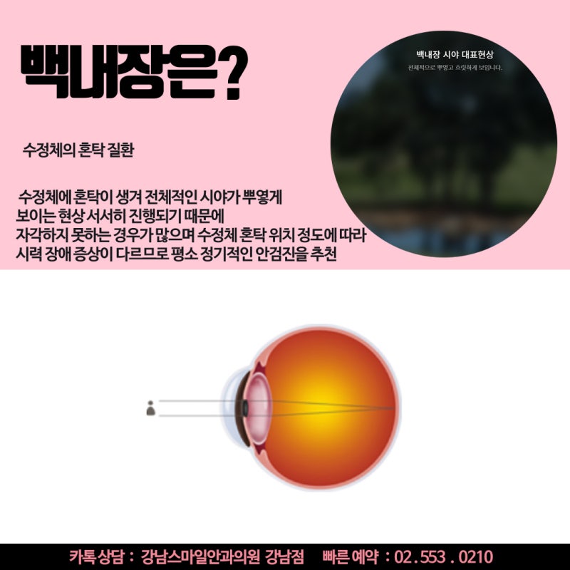 Why Presbyopia and Cataracts Are Often Confused, and Why Regular Eye Exams Are Essential! 사진 5