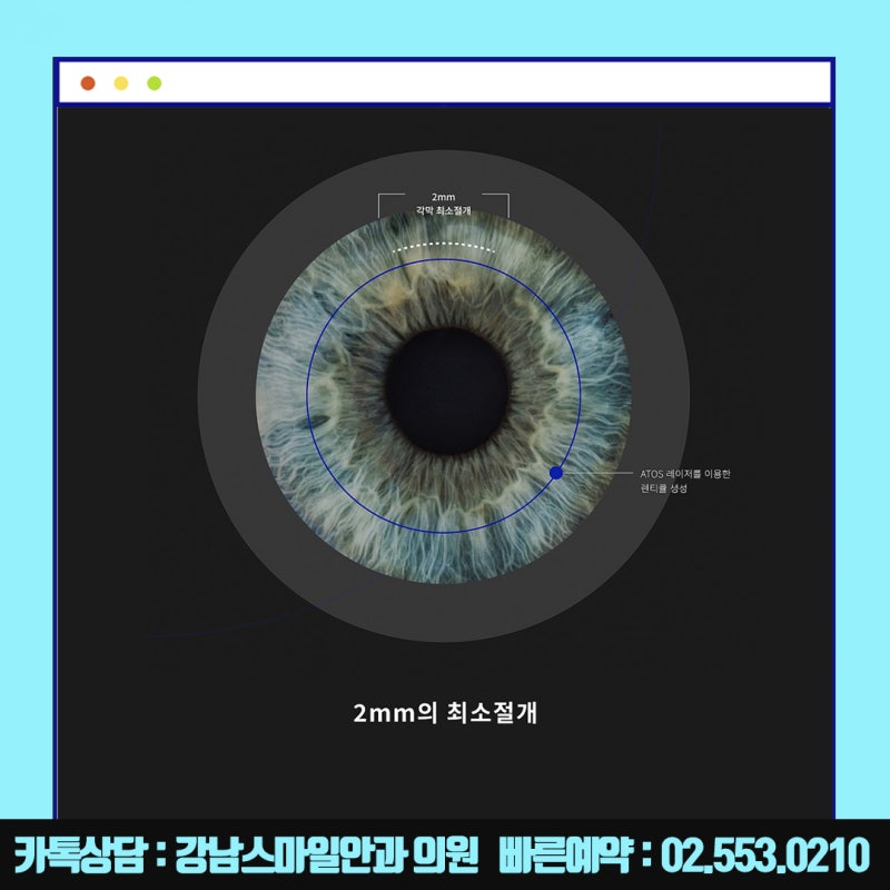 การผ่าตัด Newsmile ในโซล, Gangnam Smile Eye Clinic ที่รู้จักกันดีในเรื่อง Lasik และ Lasek : ) 사진 8