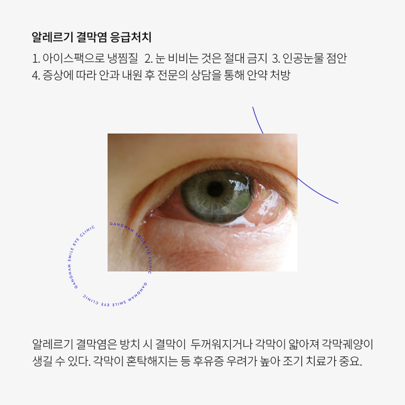 Conjunctivitis We Might Experience! Eye Disease Management Also Checked at the Ophthalmologist!! 사진 3