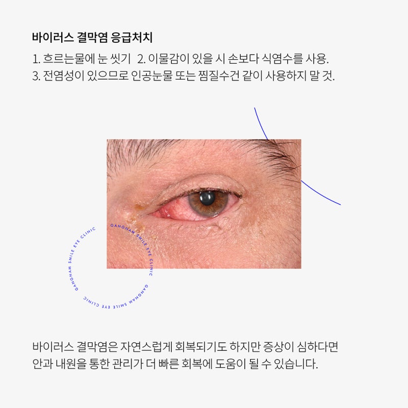 Conjunctivitis We Might Experience! Eye Disease Management Also Checked at the Ophthalmologist!! 사진 5