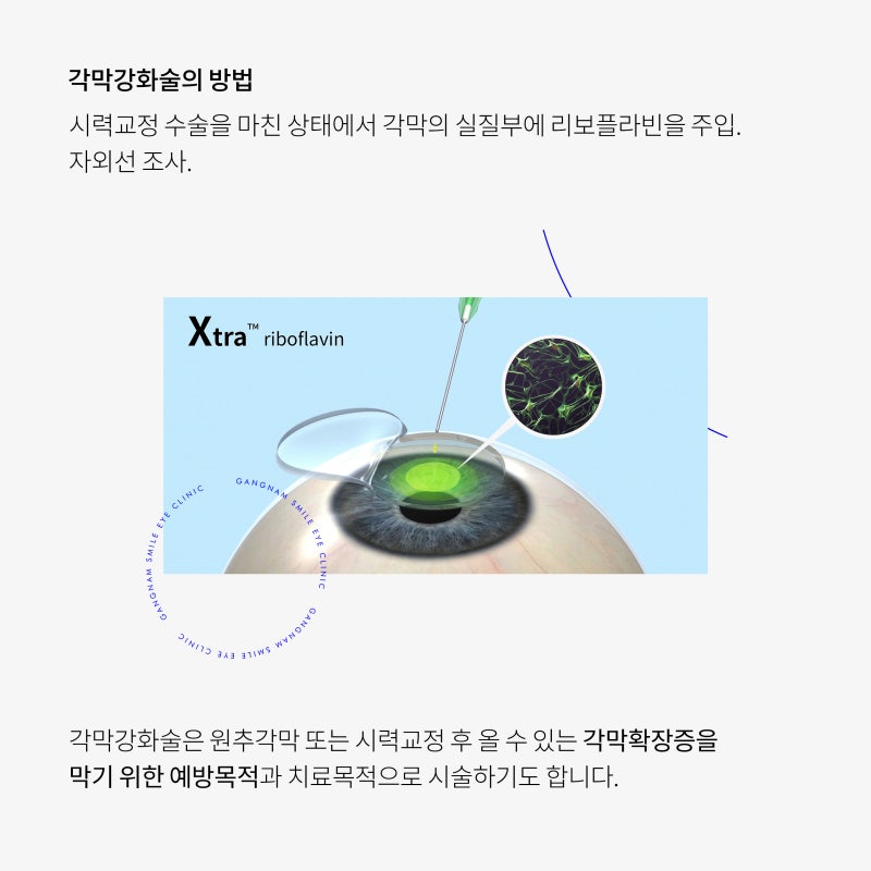 การผ่าตัด LASIK/LASEK จำเป็นต้องมีการเสริมความแข็งแรงของกระจกตาหรือไม่? 사진 5