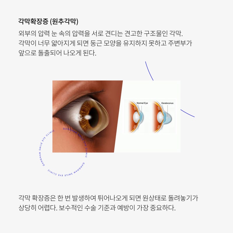 การผ่าตัด LASIK/LASEK จำเป็นต้องมีการเสริมความแข็งแรงของกระจกตาหรือไม่? 사진 4