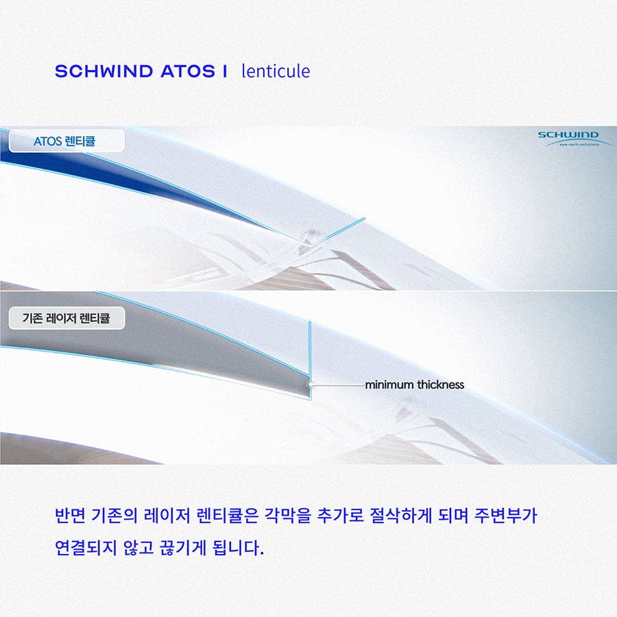 스마일수술의 가장 이상적인 형태 사진 3