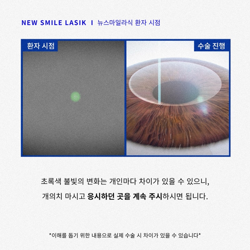 Góc nhìn của bệnh nhân phẫu thuật New Smile LASIK (ngôi thứ nhất) 사진 5