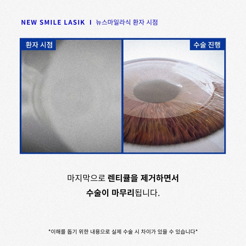 Góc nhìn của bệnh nhân phẫu thuật New Smile LASIK (ngôi thứ nhất) 사진 7