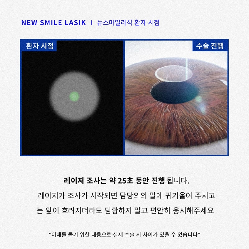 Góc nhìn của bệnh nhân phẫu thuật New Smile LASIK (ngôi thứ nhất) 사진 4