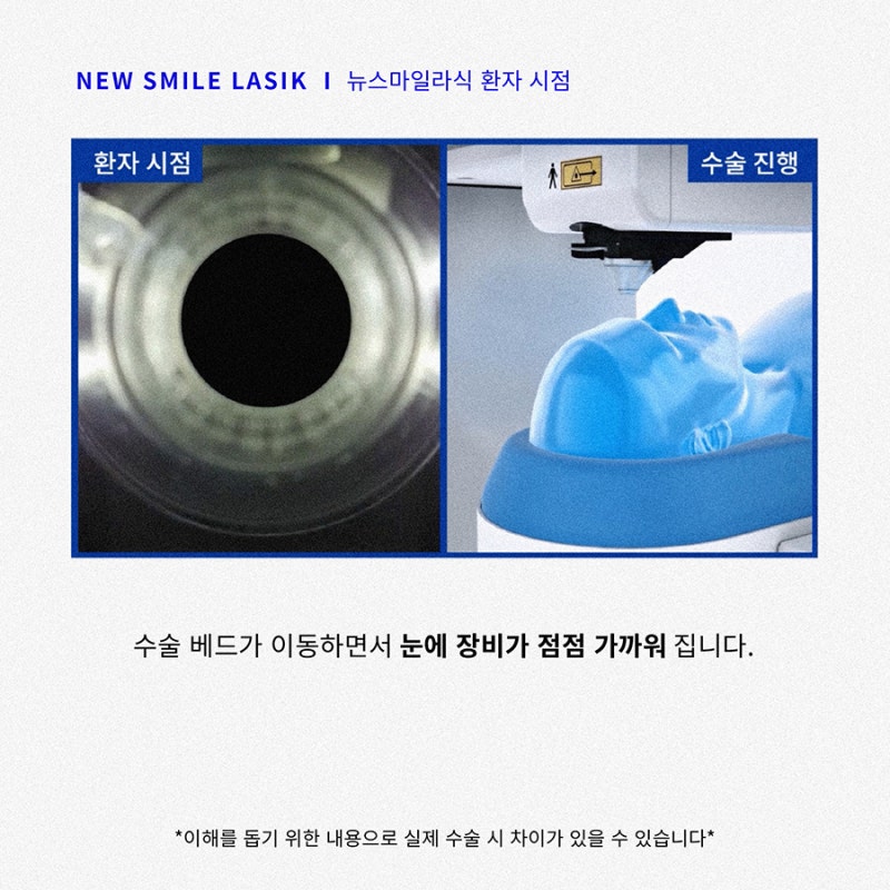 Góc nhìn của bệnh nhân phẫu thuật New Smile LASIK (ngôi thứ nhất)